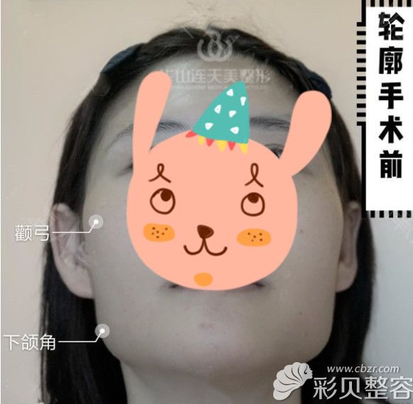 下颌角截骨和颧骨整形前