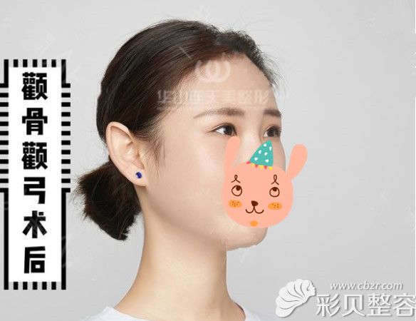 颧骨整形效果怎么样