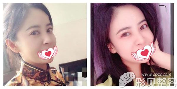 鼻梁骨歪斜三个月的恢复效果图