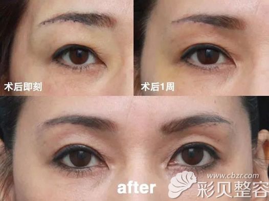 切眉术后二十天的照片