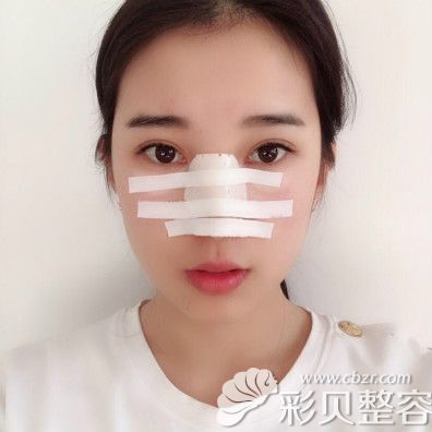 鼻基底填充第2天照片