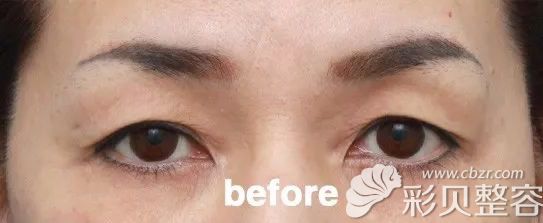 45岁上眼皮松弛做切眉好还是双眼皮好