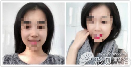 膨体垫鼻基底前后对比照