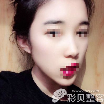 膨体垫鼻基底第15天恢复效果图