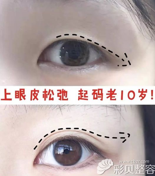 单眼皮、上睑皮肤松弛的妹子割双眼皮效果图