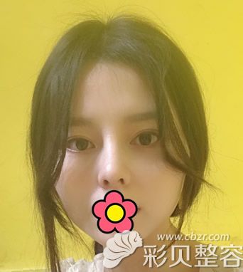 武汉柠悦耳软骨综合隆鼻6个月效果怎么样