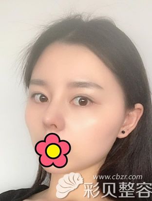 隆鼻3个月鼻头会低多少