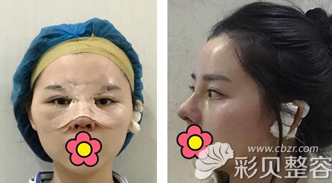 隆鼻1到7天恢复过程图片