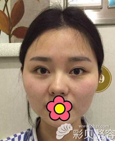 武汉柠悦整形医院耳软骨隆鼻前