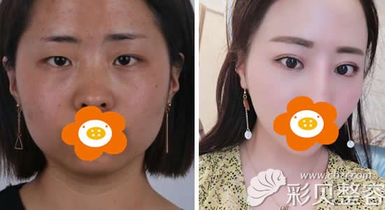 晏义兵做双眼皮隆鼻前后对比图