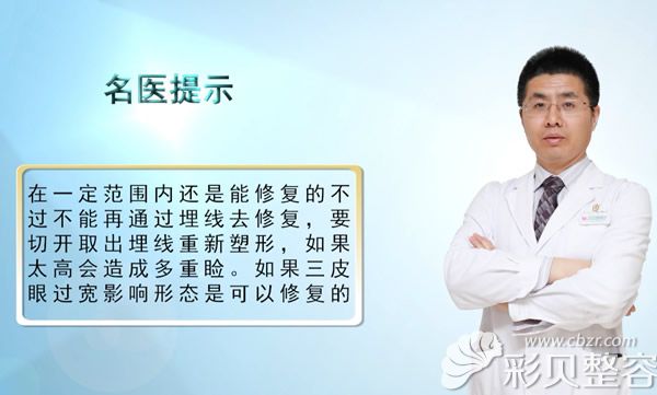 双眼皮太宽在一定范围内是可以修复的