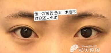 埋线双眼皮失败不对称图片