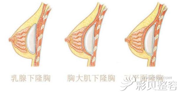 隆胸假体放置的位置