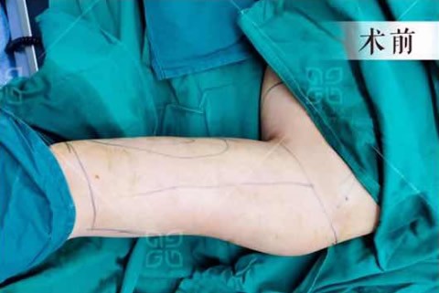 广州雅丽达瘦手臂抽脂经历:本以为20天胳膊才能变细,没想到.