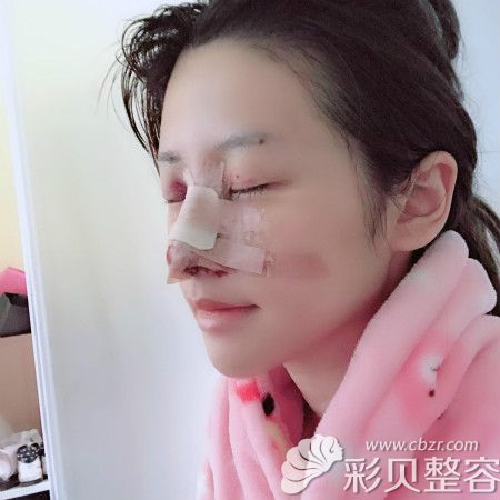 我找广州美莱田跃平做半肋骨术后第6天样子