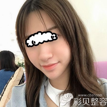 广州美莱田跃平给我做肋骨鼻术前样子