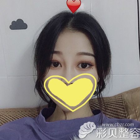 我找广州美莱陈贵宗做双眼皮综合手术四个月效果很满意