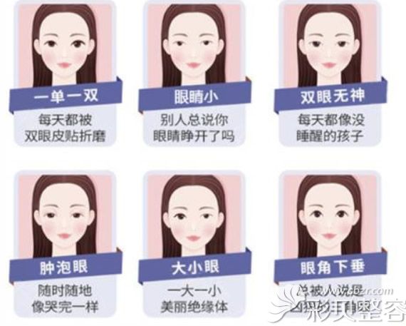 Park法双眼皮可以改善哪些眼部问题