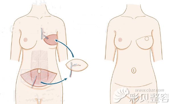 腹部组织乳房重建后的效果图 
