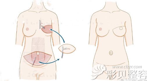 腹部真皮瓣乳房重建原理