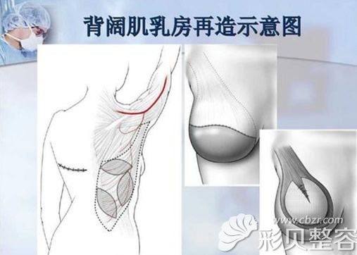 背阔肌再造乳房手术原理示意图