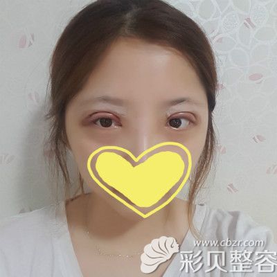 韩国郑在祐给我修复双眼皮术后第5天效果图