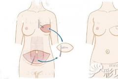 乳房自体重建肚子上留疤大吗?10年后做激光祛疤能消除不?