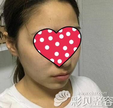 骨性偏颌脸歪,自我矫正没用后花6万在广州广大做了正颌手术