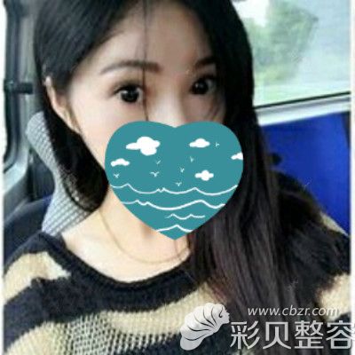 找金华亚美胡华兵做双眼皮提肌去脂恢复三个月效果图