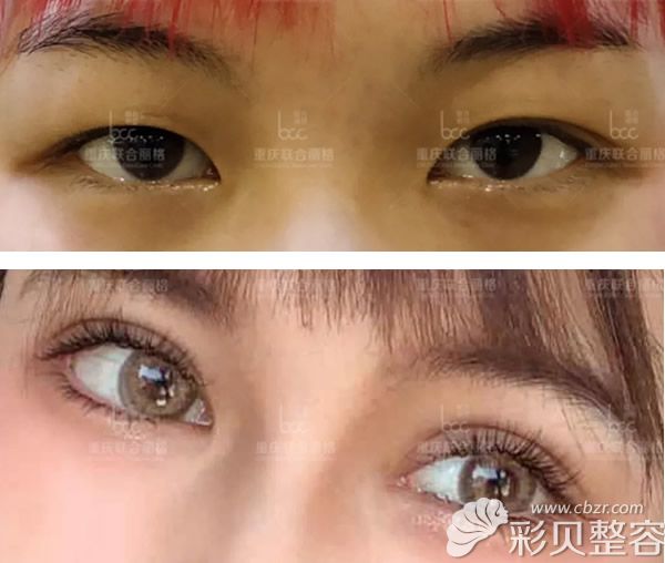 看重庆联合丽格党宁割双眼皮技术怎么样