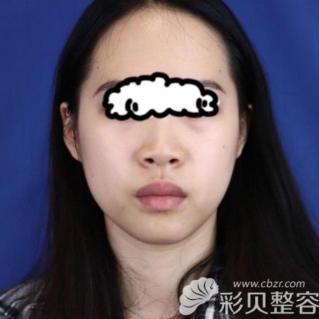 我找广州积美孙峰医生做隆鼻术前照片