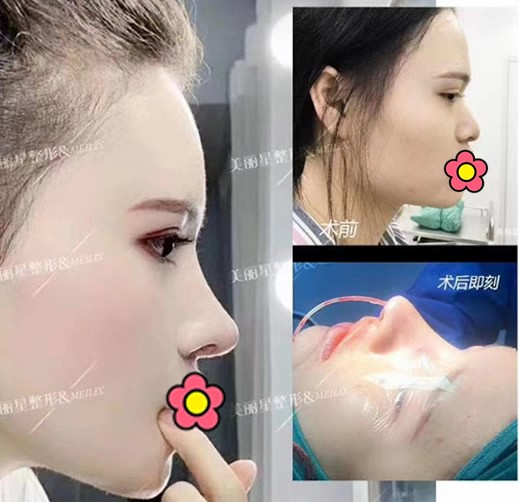 通过鼻综合对比案例照片,看南宁美丽星李武斌做鼻子怎么样?