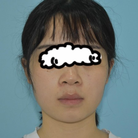 成都雍和华仁刘培医生给我做的舒铂超肋鼻,3年后没吸收变低