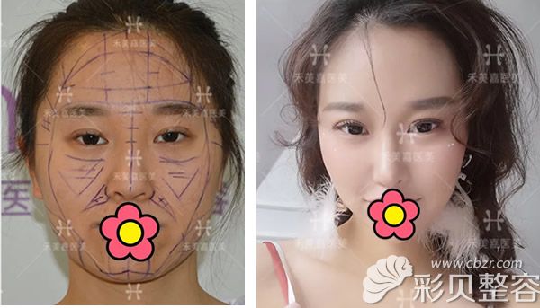 北京禾美嘉任学会给我做自体脂肪面部填充前后<span style=
