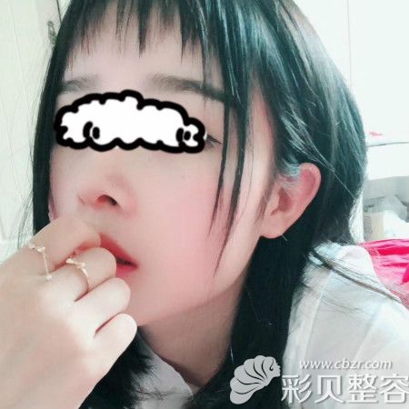 在成都雍和华仁让刘培医生做鼻子术后一年效果图