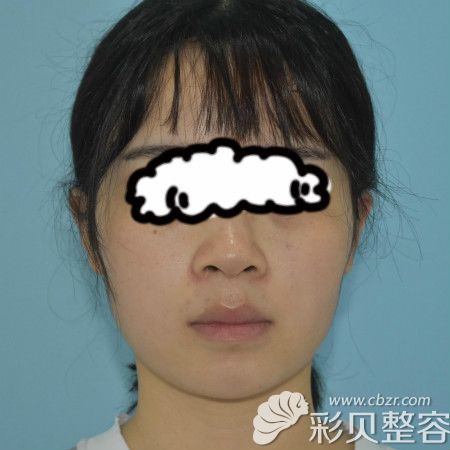 去成都雍和华仁找刘培医生做隆鼻术前素颜照片