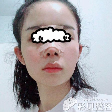 成都雍和华仁刘培院长给我做舒铂超肋骨隆鼻术后第三天样子