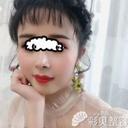 我花5万找成都雍和华仁刘培院长做舒铂超肋鼻子综合术后三年效果