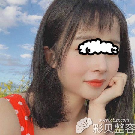 成都雍和华仁刘培院长给我做舒铂肋骨鼻术后一个月效果