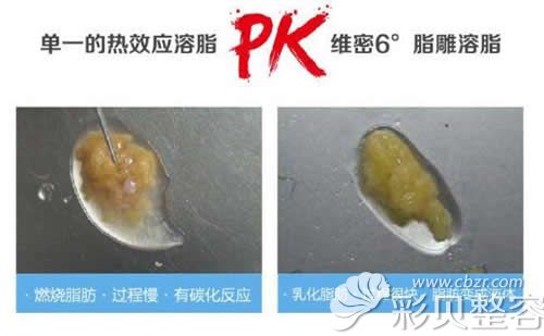 北京京韩维密6度脂雕修复手术对比普通溶脂修复技术优点