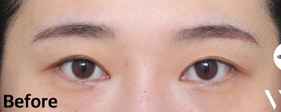 做完双眼皮1年大小眼很明显,来韩国百利酷做了失败修复手术