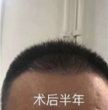 山西晋城植发医院哪家好?他俩在芳华医院种植的,看效果如何