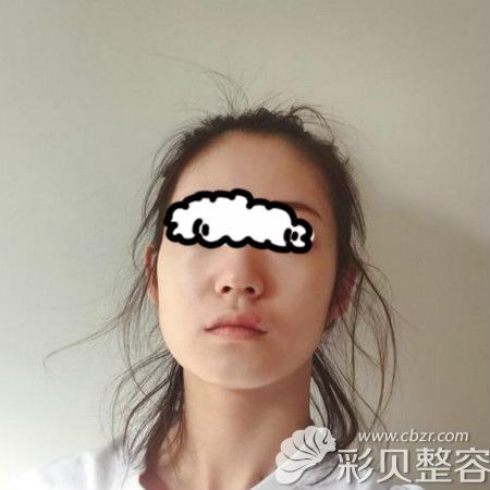 我找重庆军美章小平做隆鼻术前照片
