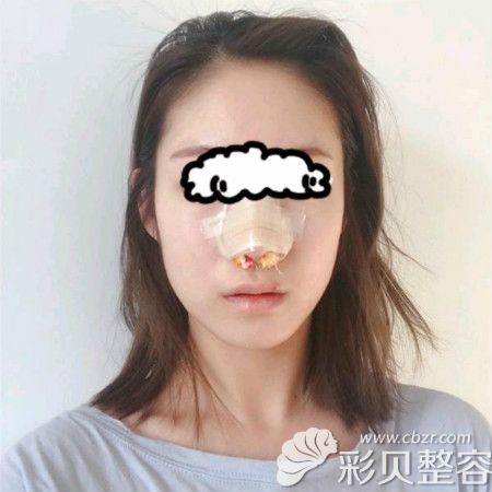 重庆军美章小平为我做韩士生科3段加耳软骨鼻尖抬高术后第3天样子