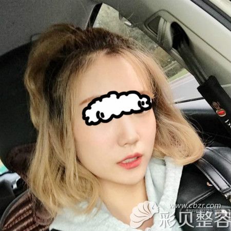 重庆军美章小平隆鼻案例:术后20天效果图片