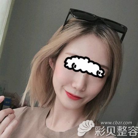 重庆军美章小平隆鼻真人案例：术后恢复三个月鼻子挺翘自然