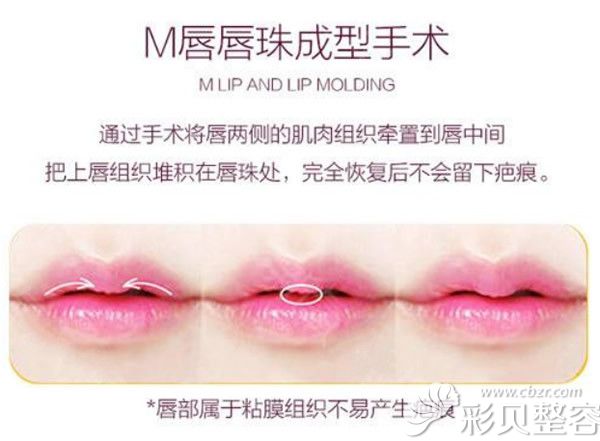 M唇手术过程