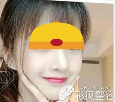 洛阳莱尔美刘战辉做鼻子怎么样？舒铂超肋鼻一个月效果图告诉你