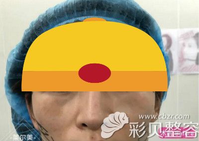 洛阳莱尔美刘战辉给我做隆鼻术前照片