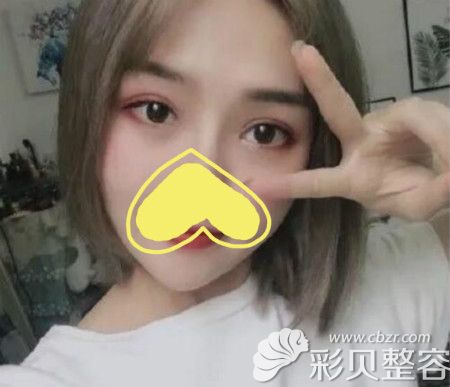 洛阳莱尔美刘战辉双眼皮案例：割双眼皮术后恢复一个月效果图片